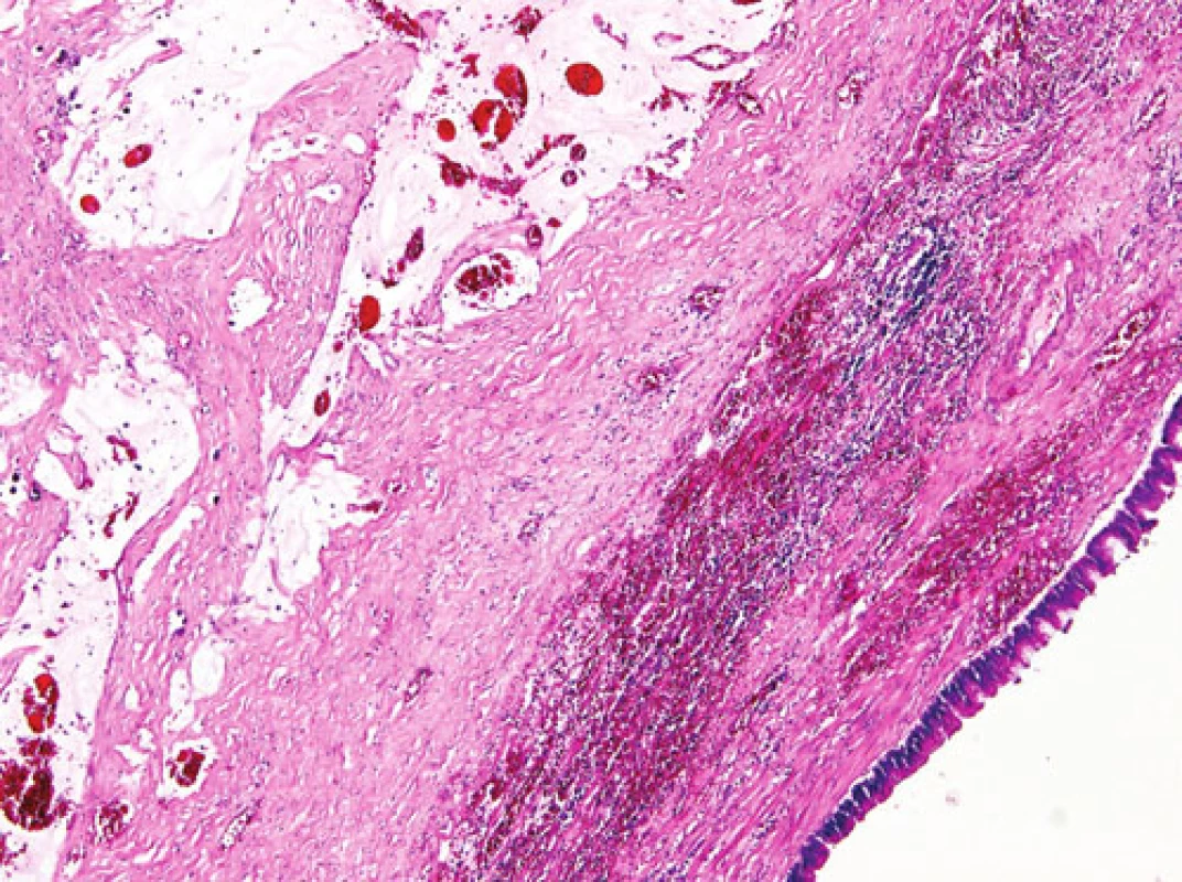 Kolekce hlenu ve stěně appendixu pod dysplastickým luminálním epitelem (HE, 48x)
Fig. 2. Collection of phlegm in the appendiceal wall below its dysplastic epithelium (HE, 48x)