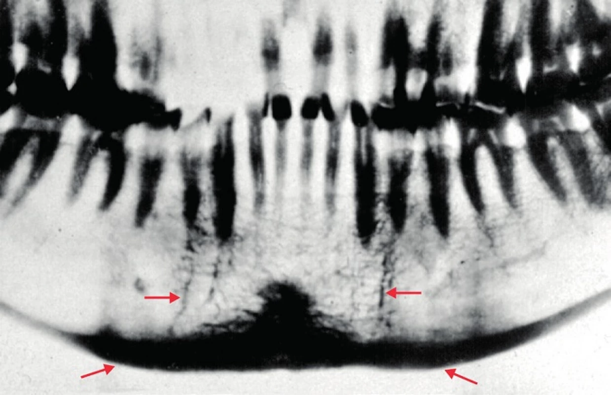 Známky lomných linií po obou stranách brady (horní šipky). Ztluštělá kortikalis dolního okraje čelisti (dolní šipky).