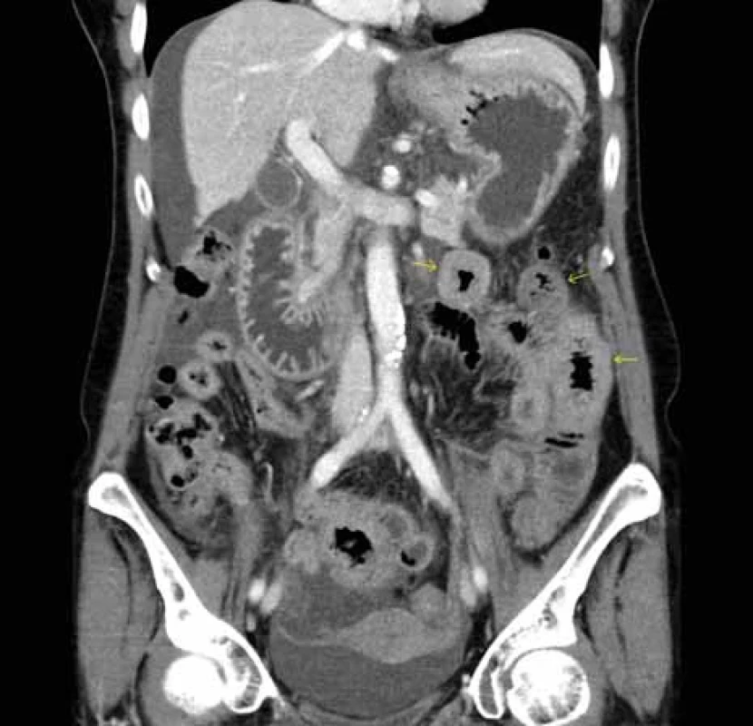 CT břicha – zesílená stěna kliček jejuna v levém mezogastriu (šipky), volná tekutina především při konvexitě jater a v okolí dělohy v malé pánvi.
