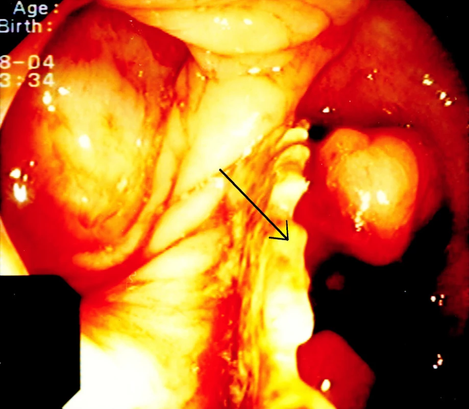 Síťka v lumen střeva
Fig. 2. The mesh within the intestinal lumen