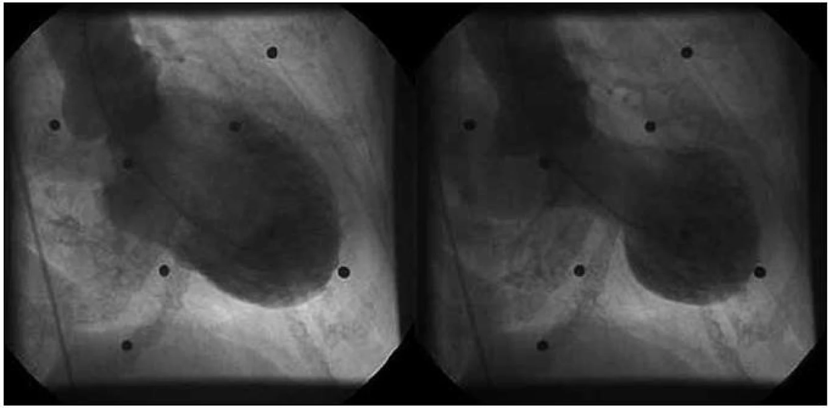 Angiografický obraz levé komory v diastole (vlevo), v systole (vpravo).
