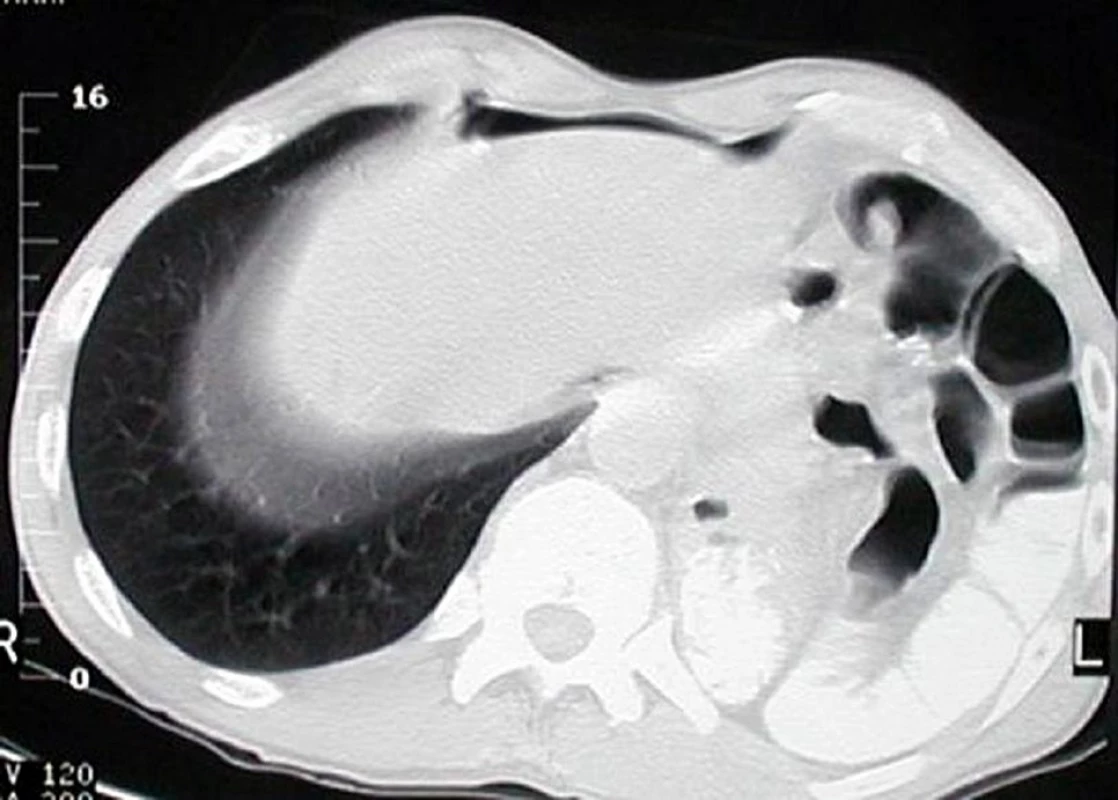 Ruptura bránice vlevo - na CT střevní kličky v levé pohrudniční dutině