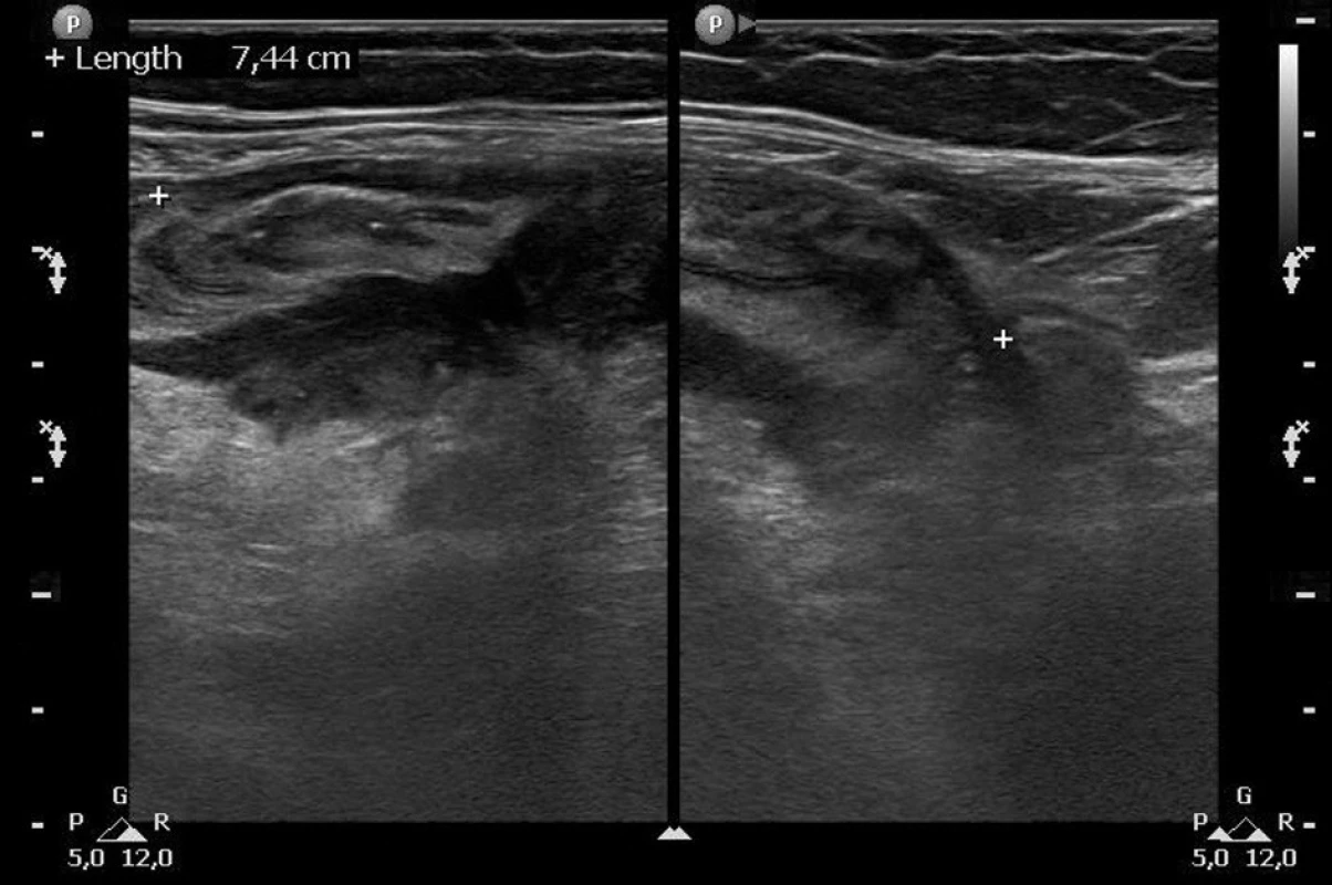Ultrazvukové vyšetření: obraz akutní divertikulitidy sigmatu s edematózním rozšířením stěny střeva