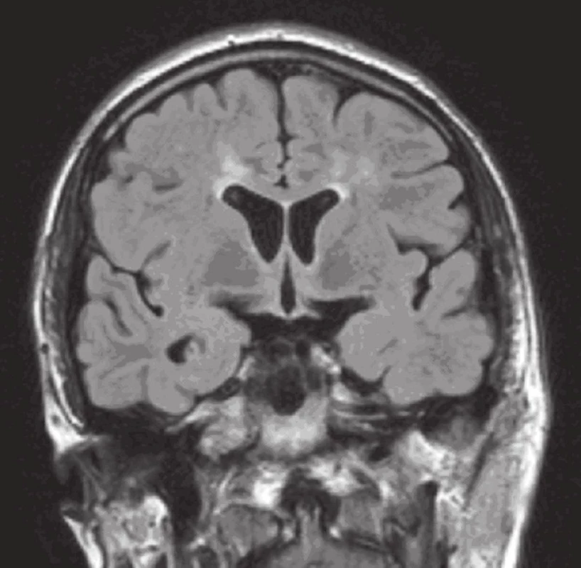 MR mozku: FLAIR koronárně (v odstupu jednoho měsíce): pouze drobné reziduální hyperintenzity kolem obou postranních komor ve frontální oblasti.