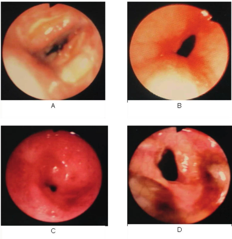 Ukázky bronchoskopických nálezů stenóz trachey
Fig. 2: Illustrations of bronchoscopic findings in tracheal stenoses