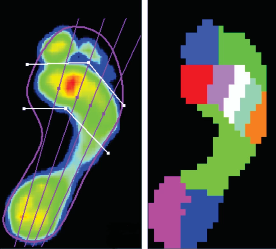 Vľavo – odtlačok plosky nohy viditeľný po chôdzi po tlakovej plošine, vpravo – rozdelenie plosky nohy na 10 anatomických zón.