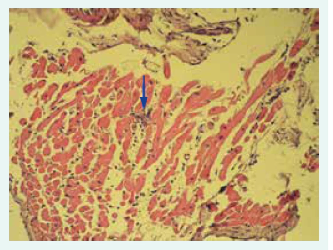 Histologický obraz lymfocytární myokarditidy: fokus inflamatorní celulizace označen šipkou.