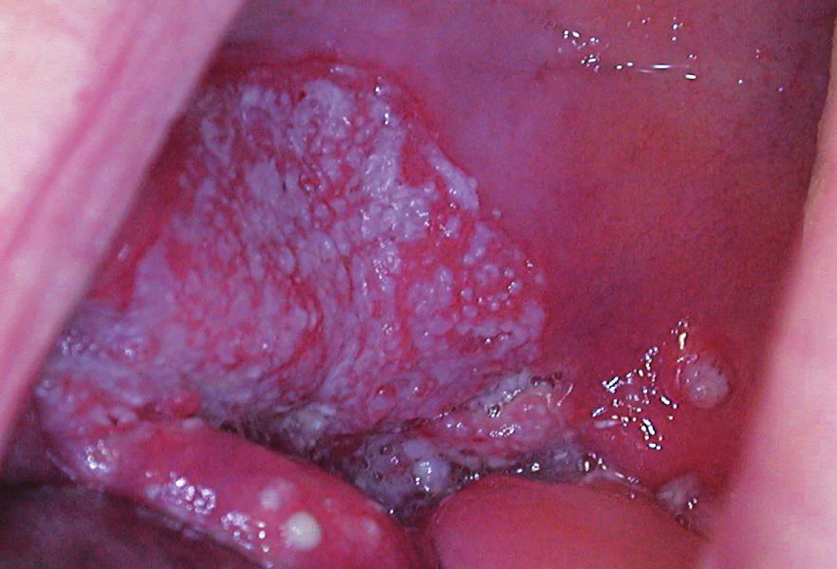 Dlaždicobuněčný karcinom dutiny ústní