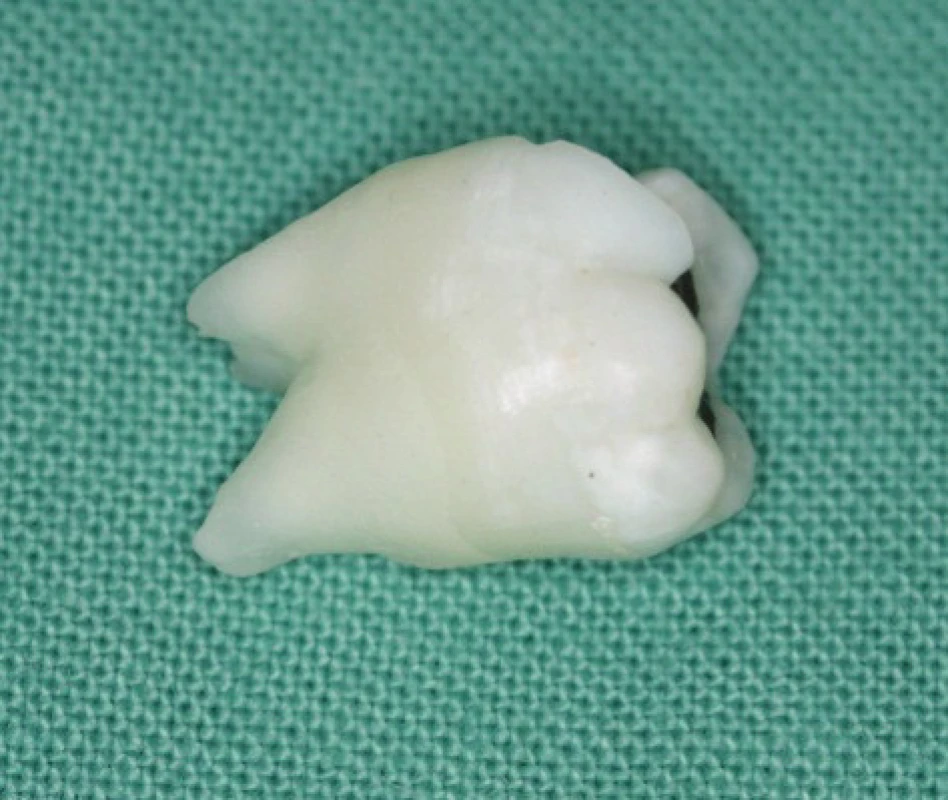 Extrahovaný malformovaný zub 37