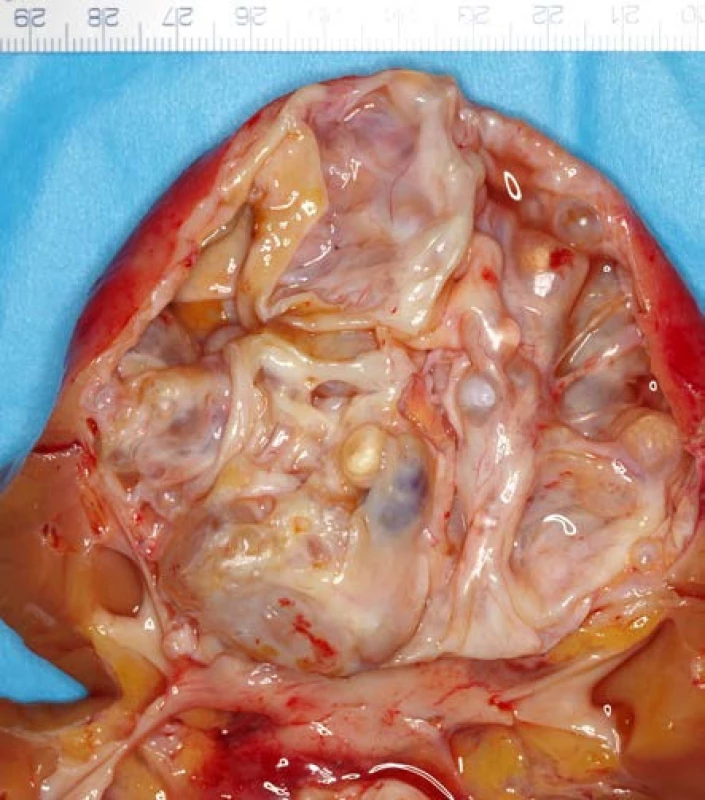 &lt;i&gt;Smíšený epiteliální a stromální tumor ledviny&lt;/i&gt;
Fig. 4. &lt;i&gt;Mixed epithelial and stromal tumour&lt;/i&gt;