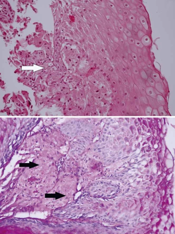 Histologický obraz granularnobunkového tumoru u prezentovaného pacienta – granulárnobunkový tumor pažeráka (šípka) tvorili skupiny buniek s objemnou zrnitou eozinofilnou cytoplazmou (A) s malými ovoidnými hyperchrómnymi jadrami a s PAS (periodic acid schiff ) pozitivitou (B). 
Fig. 3. Histology of granular cell tumour in the presented patient – oesophageal granular cell tumour (arrow) consisted of nests of cells with sizeable granular eosinophilic cytoplasm (A) with small ovoid hyperchromatic nuclei with PAS (periodic acid-Schiff ) positivity (B). A. haematoxylin/eosin ×200; B. PAS ×200.