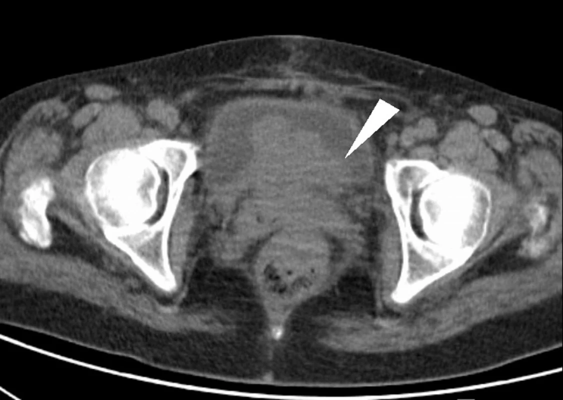 CT vyšetření, axiální skeny: rozsáhlý tumor malé pánve, postihující rektum, pochvu a močový měchýř – indikace k totální pelvické exenteraci (bílá šipka)
Fig. 2: CT – axial scans: advanced tumour of small pelvis, invading the rectum, vagina and urinary bladder – indication for total pelvic exenteration (white arrow)