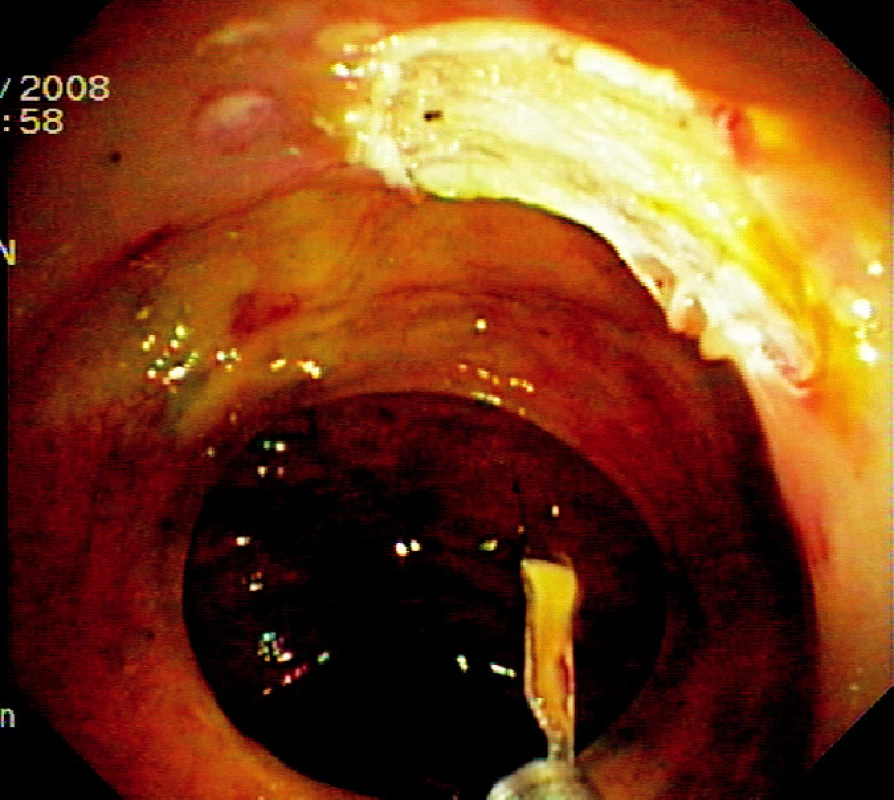 Spodina po endoskopické slizniční resekci
Pic. 3. The base after endoscopic mucosal resection