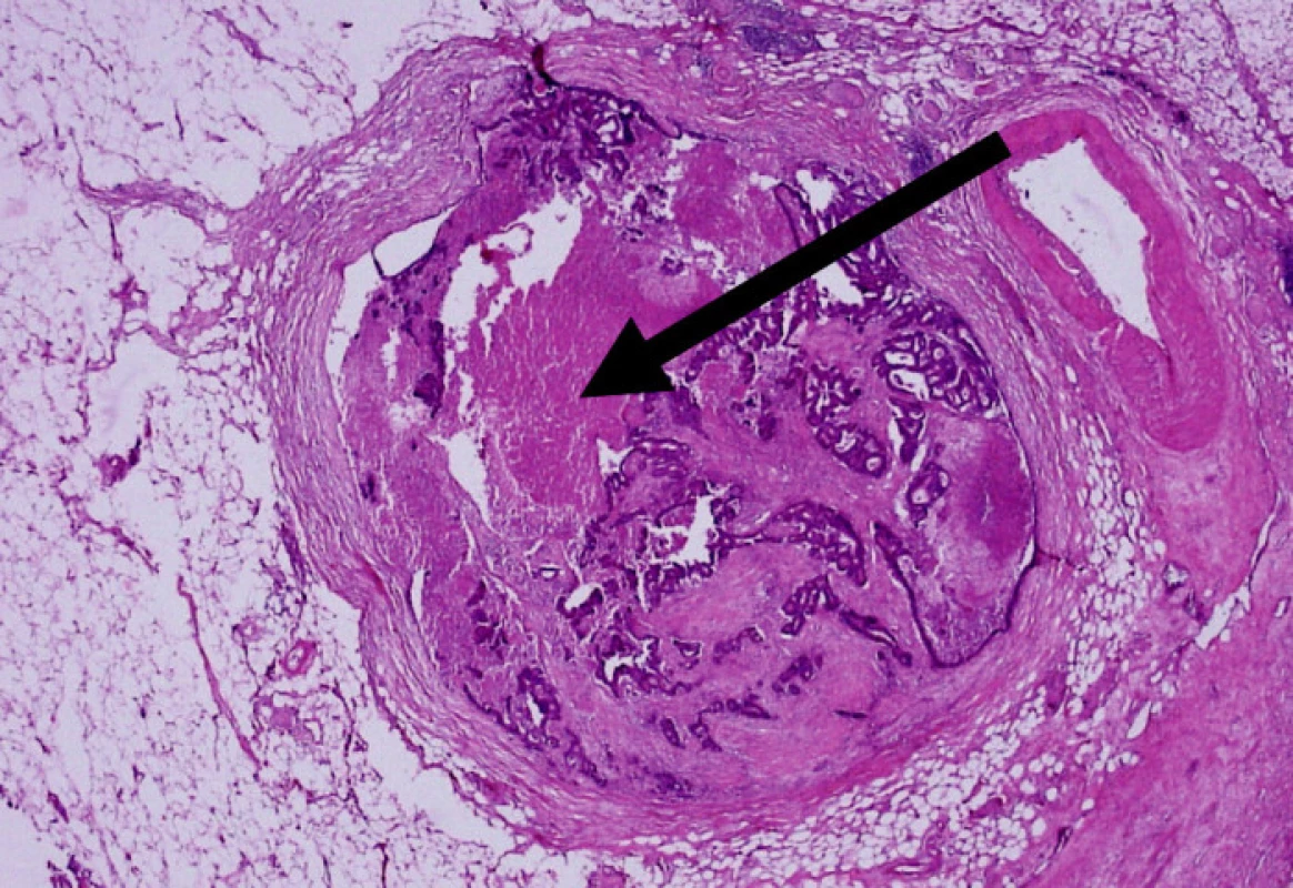 Extranodální nádorové depozitum s vazivovým pouzdrem bez přítomnosti lymfatické tkáně (HE, 20x)
Fig. 3. Extranodal tumor deposit with fibrous capsule without lymphatic tissue (HE, 20x)