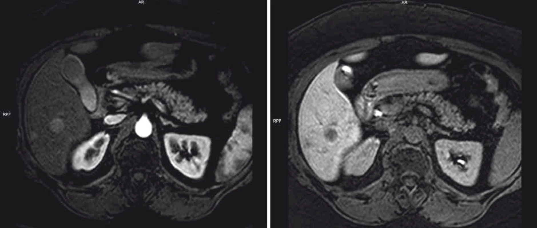 Obraz jaterního postižení charakteru metastáz dle MRI.