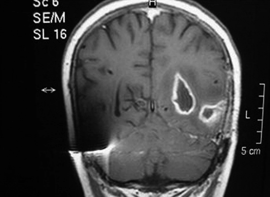 Mykotický mozkový absces u pacienta č. 2, 49 dní po transplantaci.
Fig. 2. Mycotic brain abscess in patient No. 2, 49 days after transplantation.