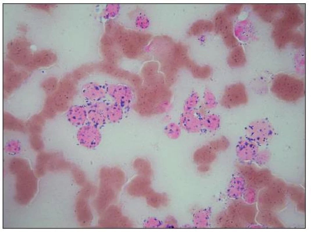 Reakce na nespecifickou alfa-naftylacetát-esterázu (ANAE) je u buněk medulloblastomu stejně jako u neuroblastomu pozitivní.