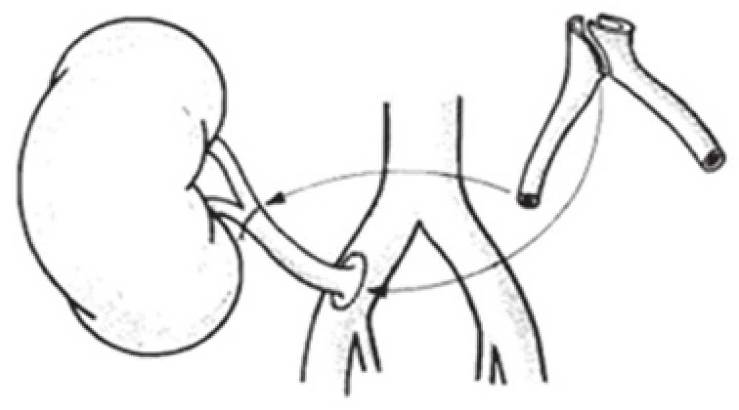 Predĺženie jednej renálnej artérie použitím darcovského vonkajšieho iliakálneho štepu [11]
Fig. 1: Extension of one renal artery using a donor external iliac graft [11]
