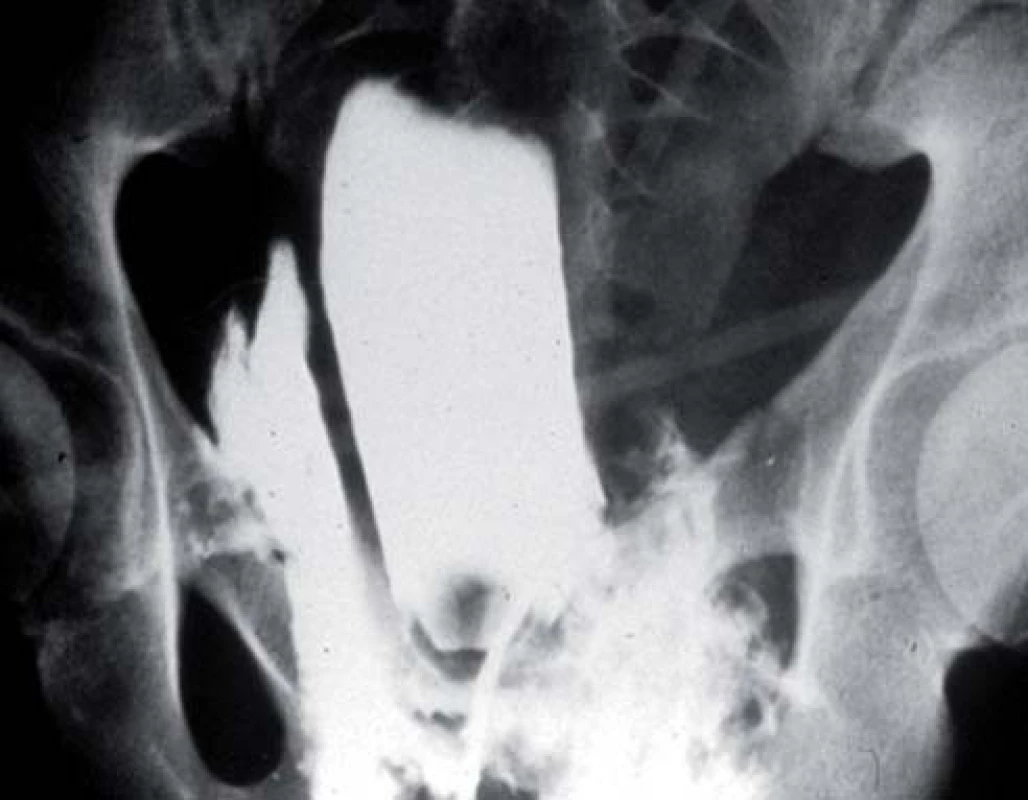 Cystografie zobrazující extraperitoneální rupturu močového měchýře.