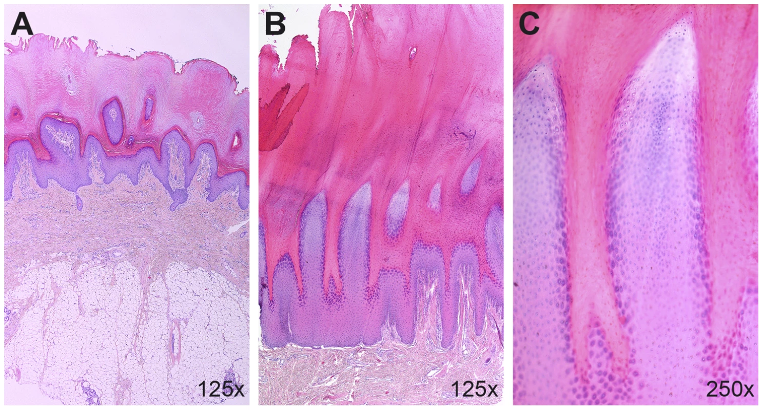 Histopathological findings in the palmoplantar epidermis.