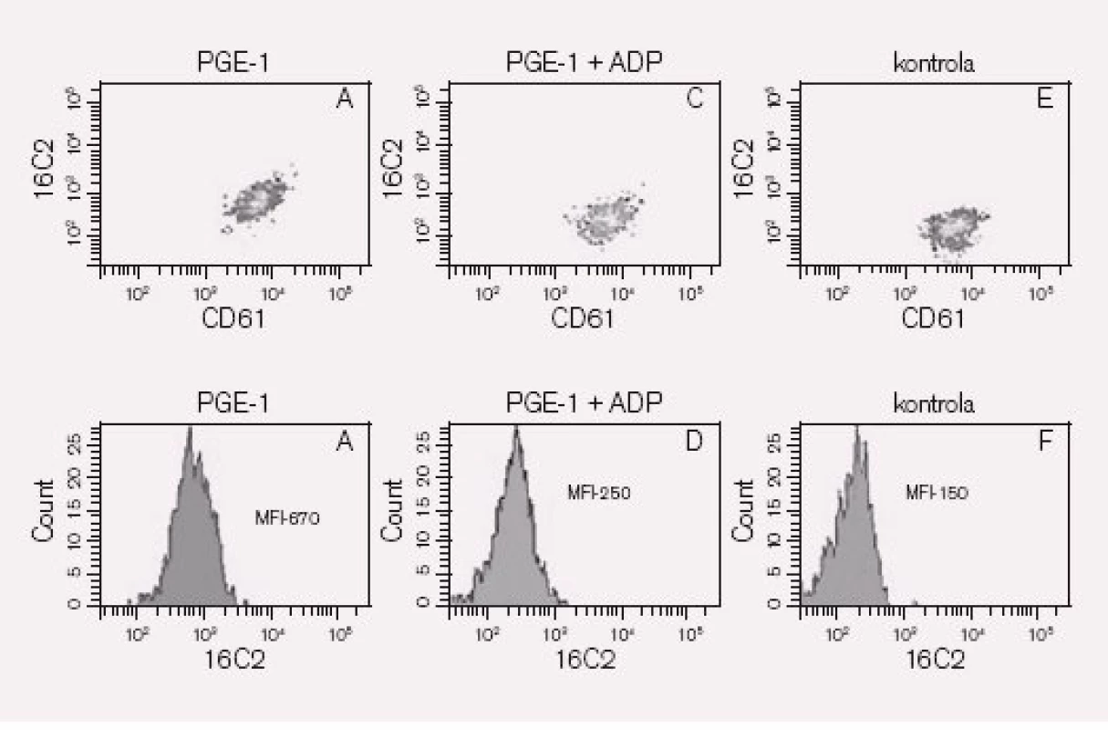 Výsledek vyšetření VASP. Trombocyty inkubujeme s PGE1 (A, B) a PGE1 + ADP (C,D). Fosforylaci VASP detekujeme po permeabilizaci trombocytů nepřímou fluorescencí za použití monoklonální protilátky &lt;sub&gt;-16&lt;/sub&gt;C&lt;sub&gt;2&lt;/sub&gt;. Stanovením PRI (Platelet Reactivity Index) podle vzorce PRI = [MFIc (PGE1) – MFIc (PGE1+ADP) / MFIc (PGE1)] × 100 hodnotíme kapacitu ADP blokovat VASP fosforylaci.