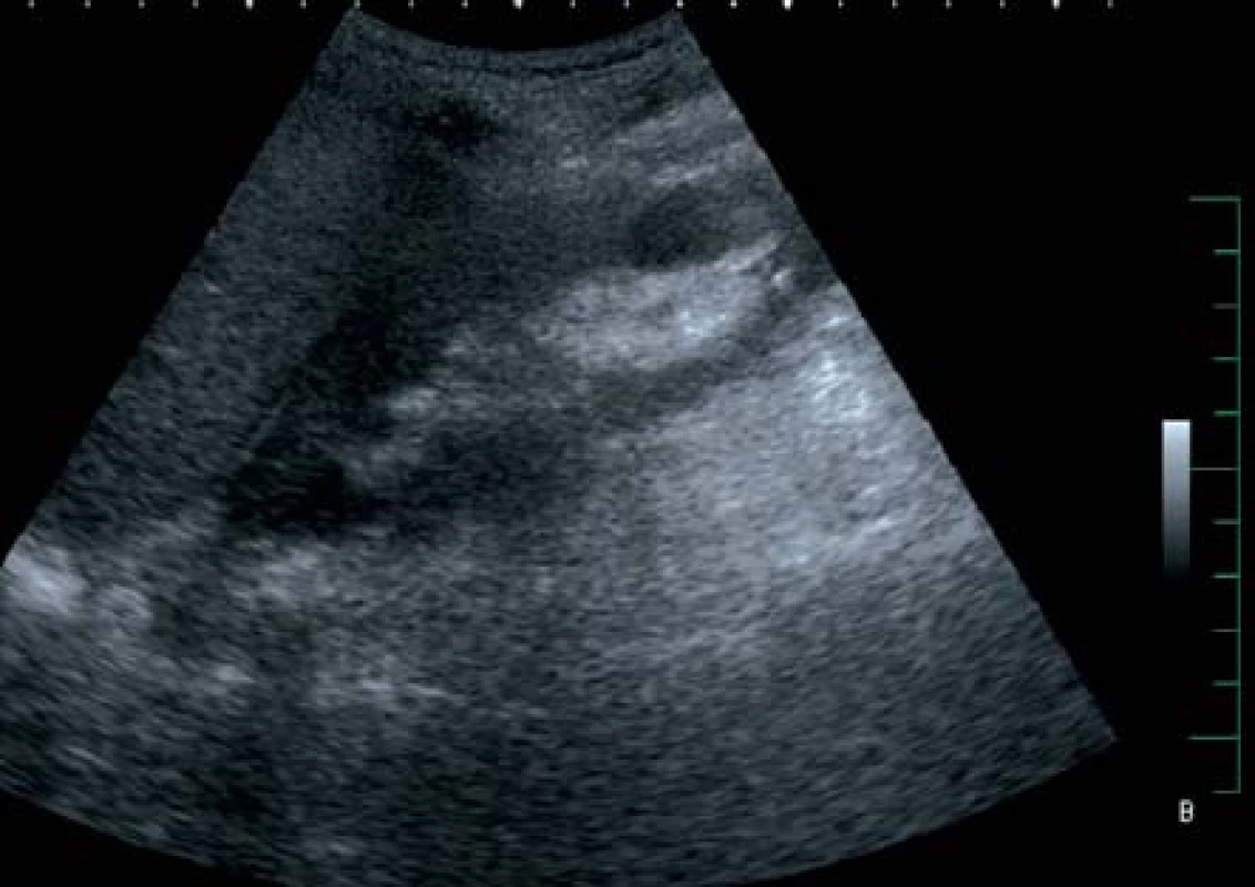 Sonografický obraz úplné reparace nálezu na pravé ledvině
Fig. 3. Complete restoration of finding in right kidney seen in ultrasound