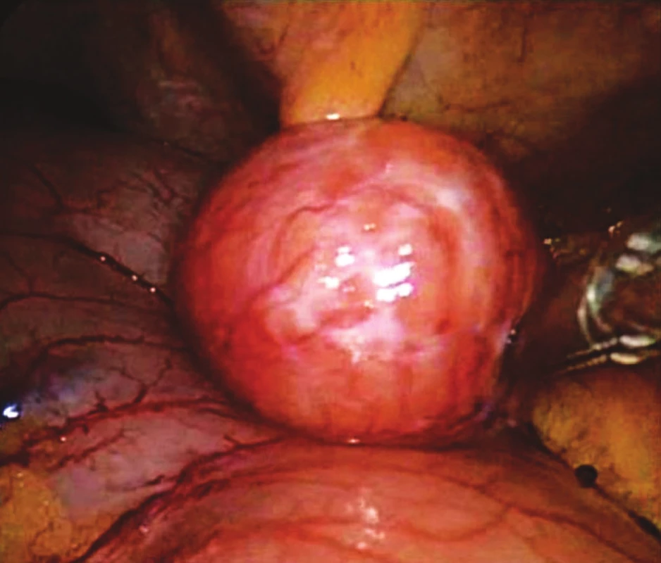 Peroperační snímek GIST žaludku
Fig. 1. Intraoperative view of gastric GIST