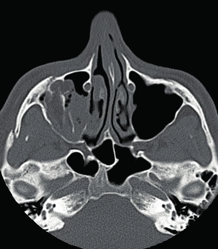 CT obraz zlomeniny lícně-čelistního komplexu
