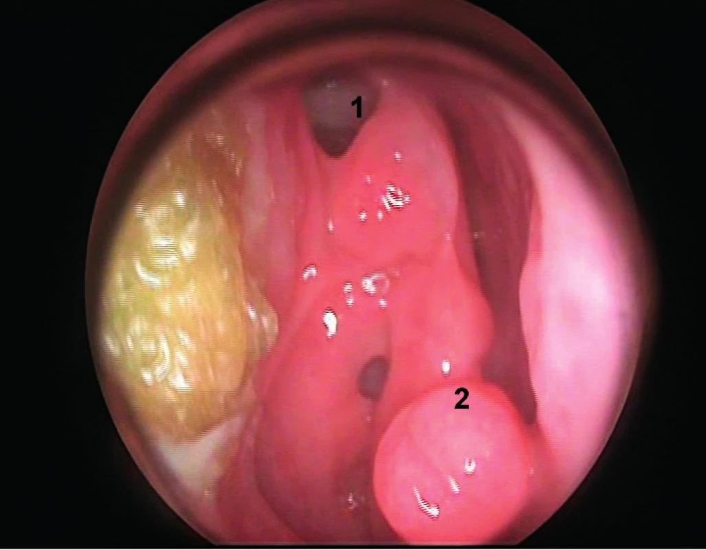 Rinoendoskopický pohľad rok od operácie, č. 1 - miesto duroplastiky, č. 2 - časť resekovanej strednej nosovej mušle.