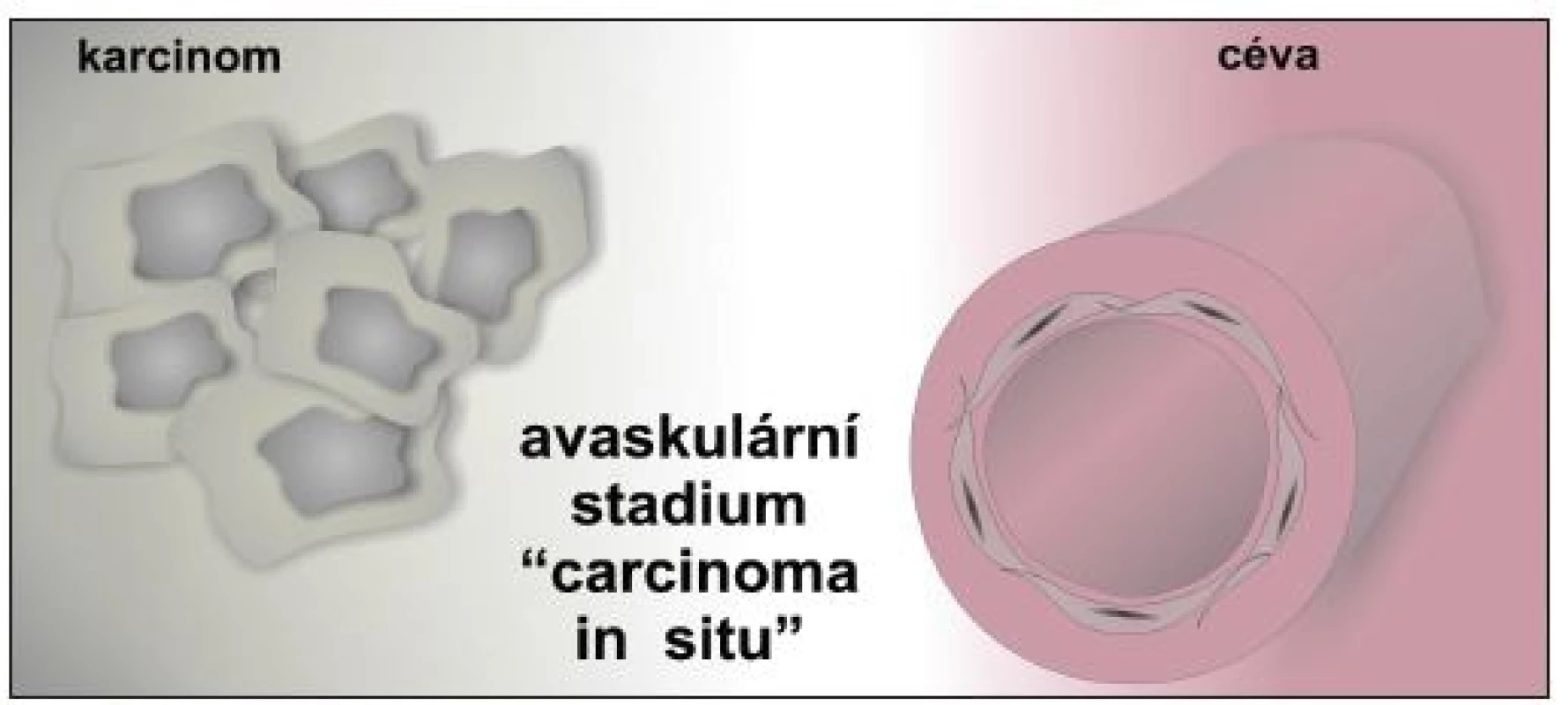 Avaskulární stadium „carcinoma in situ“ bez vlastního cévního zásobení, dodávka živin a kyslíku nádorovým buňkám je zajišťována difúzí.