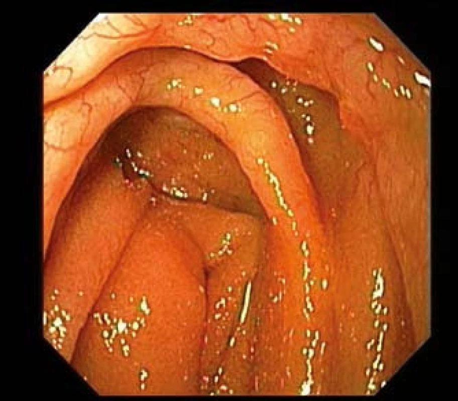 MALT lymfom jejuna u 43letého pacienta s Crohnovou chorobou. Gastroskop zavedený do oblasti duodenojejunálního přechodu prokazuje infiltraci slizničních řas s zřetelnou patologickou neovaskularizací.
Fig. 3. MALT lymphoma of the jejunum in 43-year-old patient with Crohn's disease. Gastroscope introduced in duodeno-jejunal transition shows infiltration mucosal folds with distinct pathological neo-vascularization.