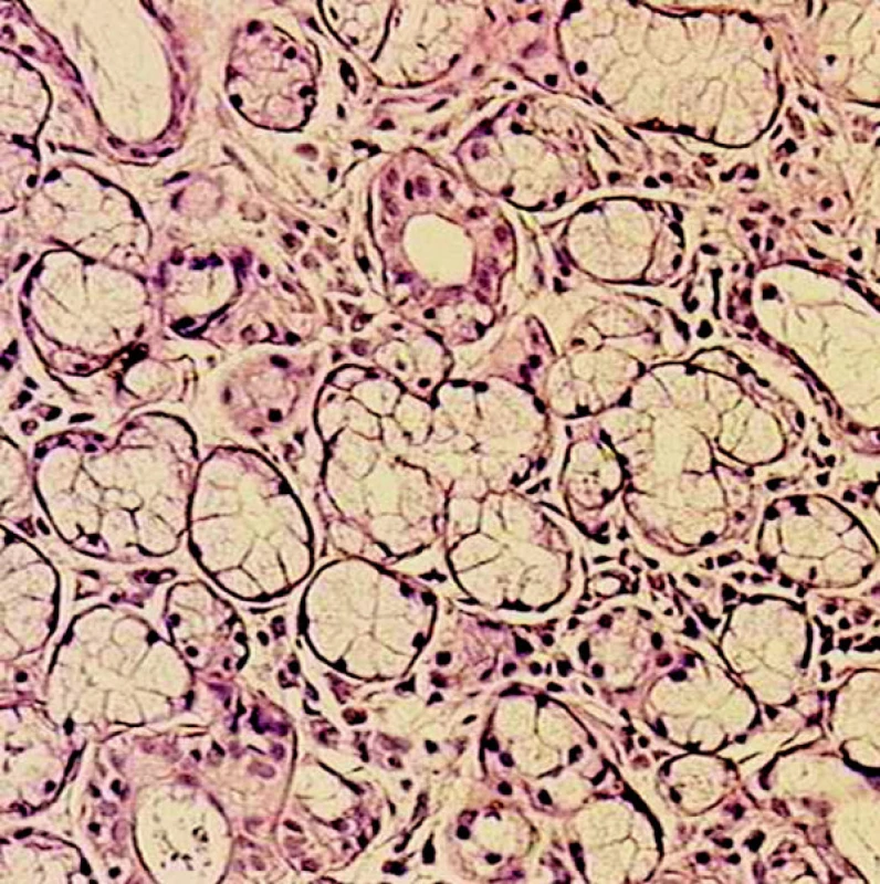 Diagnóza Sjögrenovho syndrómu nepodporená: negatívny nález biopsie malých slinných žliaz z dolnej pery (hematoxylín-eozín, 100x zväčšené).