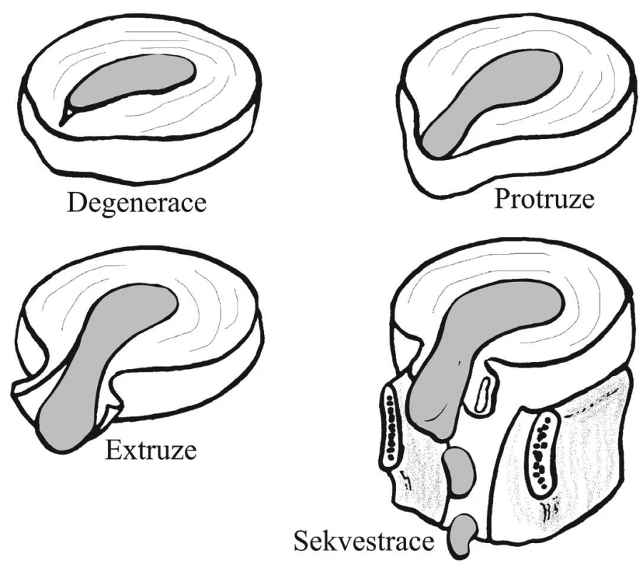 Stadia herniace intervertebrálního disku