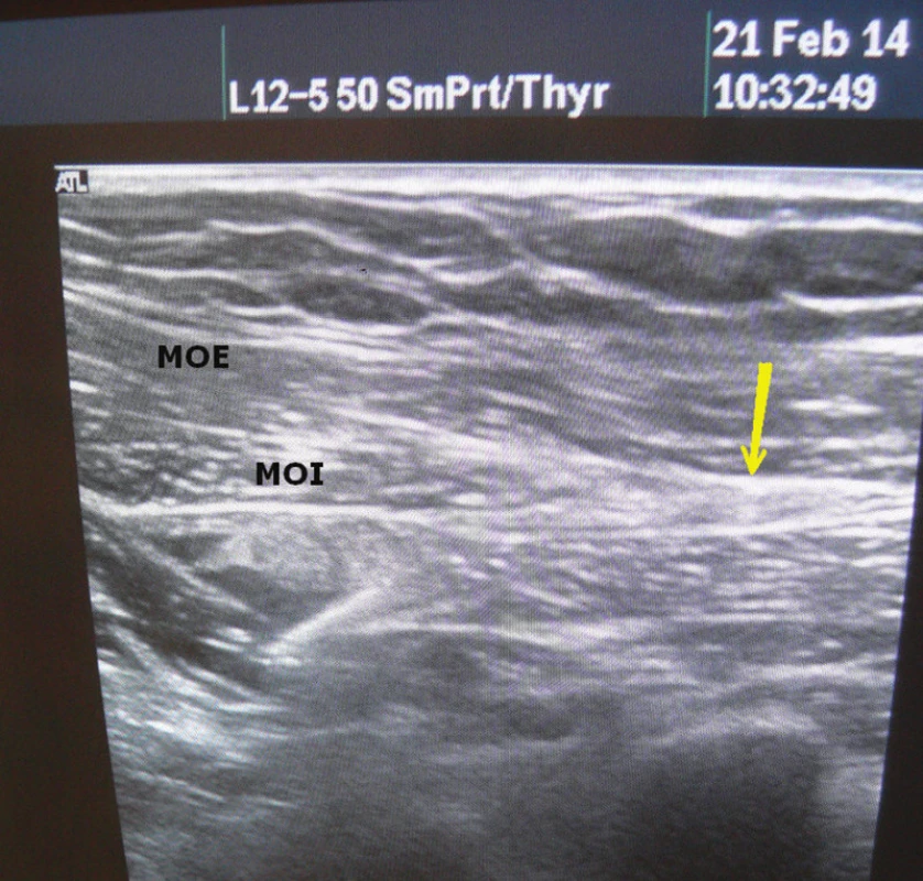 Ultrazvuk břišní stěny
Žlutá šipka – místo pro komponent separaci.
Fig. 8: Ultrasound of the abdominal wall
Yellow arrow – level of component separation.