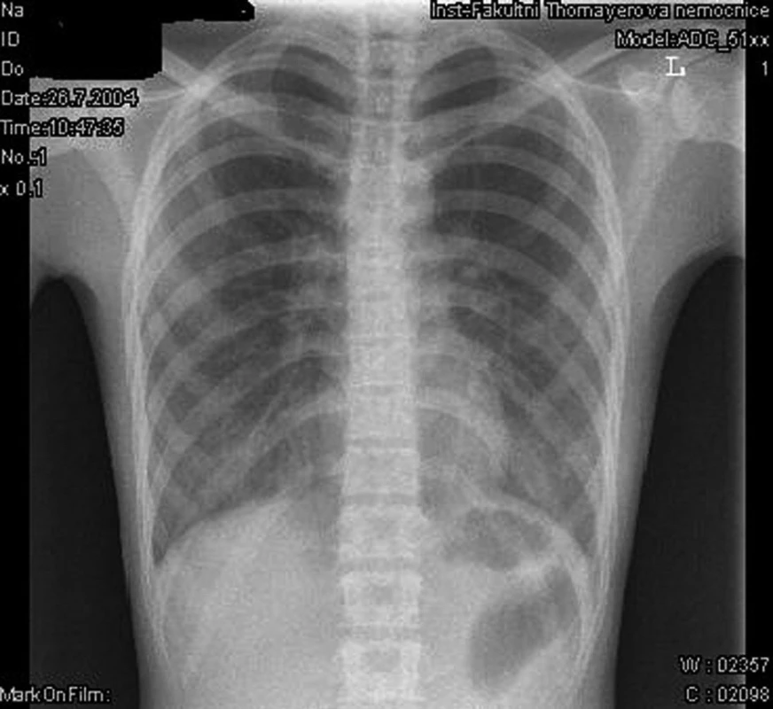 Rentgenový snímek plic.
Fig. 1. X-ray picture of the lung (chest).