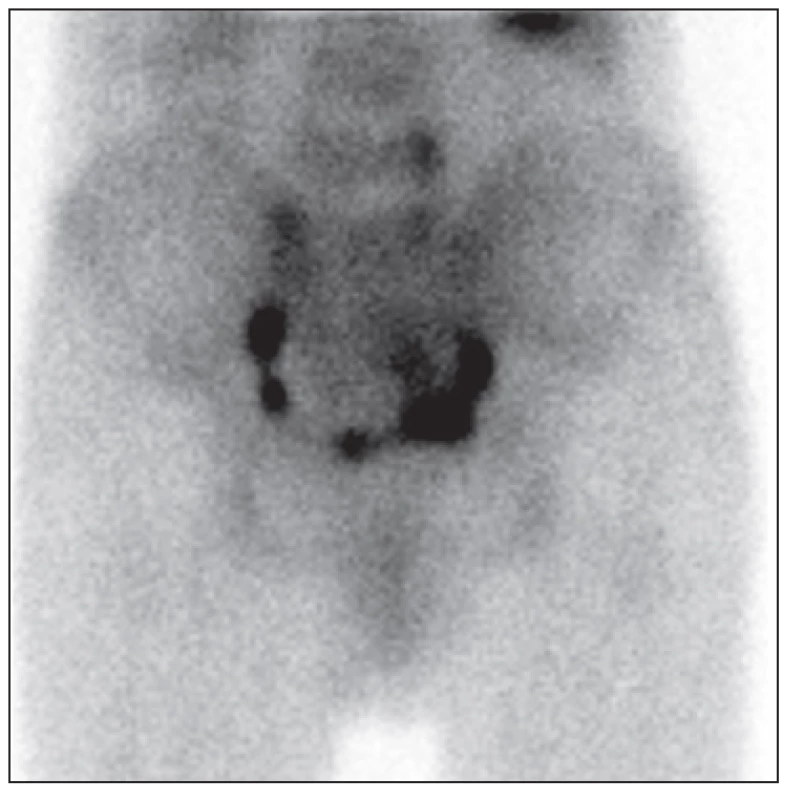 &lt;i&gt;Třífázová scintigrafie skeletu – 2. fáze (zadní pohled): zobrazuje se ložisko se zvýšenou tkáňovou perfuzí v oblasti os sacrum vpravo.&lt;/i&gt;