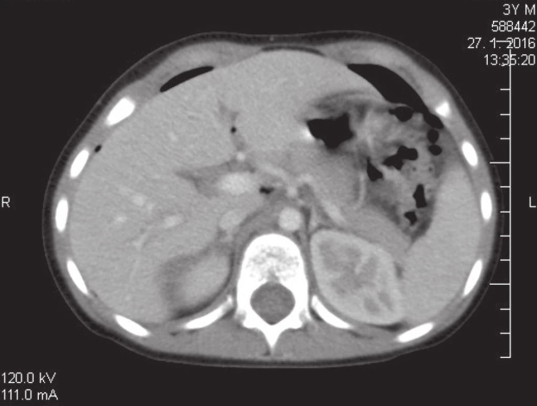 Abdominal CT scan: extra intestinal air and free intra- peritoneal fluid seen on the abdominal CT scan, with no solid organ injury.