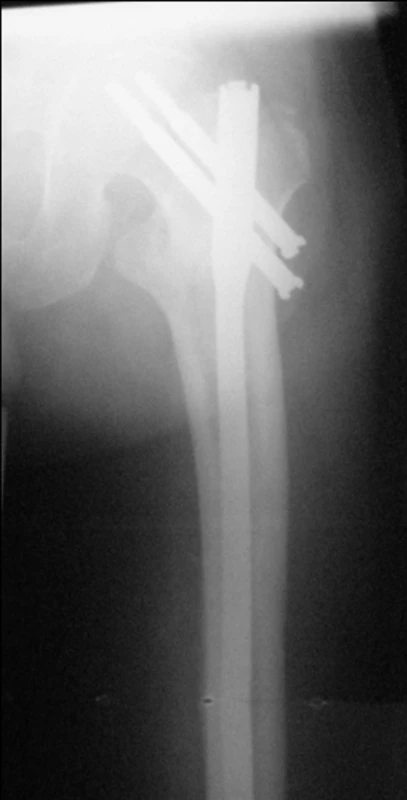 Rozlomení diafýzy při zavádění hřebu: a – pertrochanterická zlomenina u 79leté ženy; b – rtg po operaci ukazující, že při operaci došlo násilným zavedením krátkého hřebu ke zlomenině femuru s nutnou peroperační konverzí na dlouhý hřeb; c – stav 6 měsíců po operaci, obě zlomeniny zhojeny.
Fig. 3: Diaphyseal fracture caused by nail insertion: a – pertrochanteric fracture in a 79 year old woman; b – postoperative radiograph showing a diaphyseal fracture caused by forced short nail insertion, with subsequent perioperative conversion to a long nail; c – 6 months after procedure, both fractures are healed.