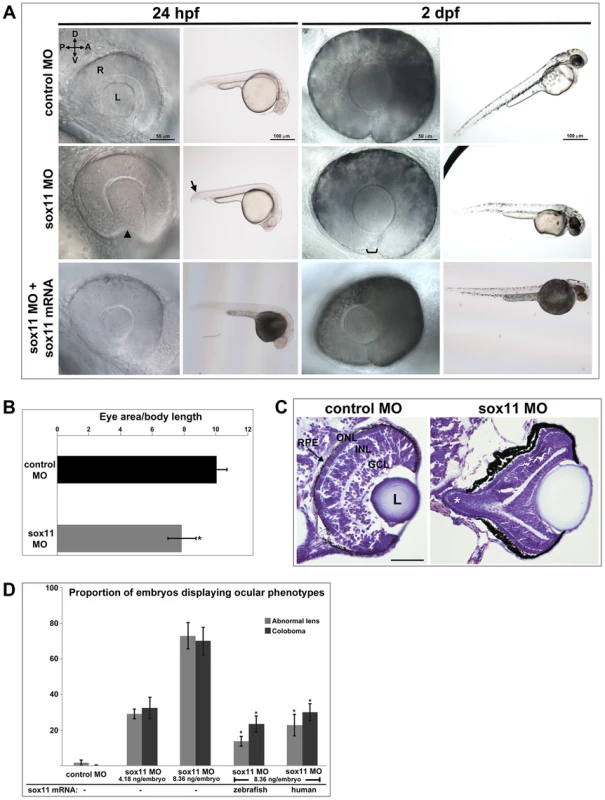 Sox11 knockdown disrupts ocular morphogenesis and causes coloboma in zebrafish.