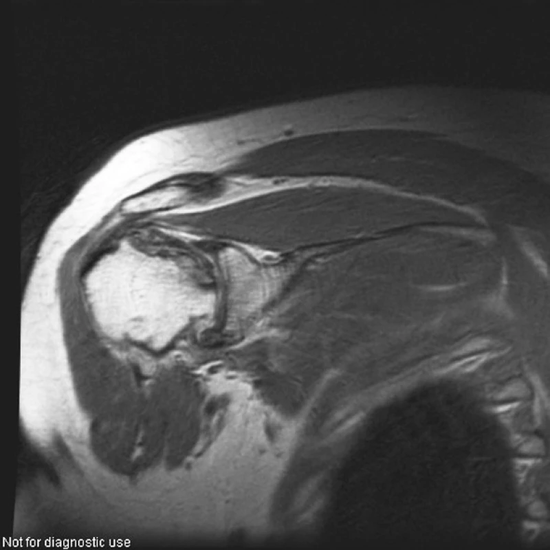 Pravé rameno (PDW obraz ve frontální rovině). Rozsáhlá osteonekróza hlavice humeru vpravo postihující celý vrchlík hlavice, s výrazným nepravidelným oploštěním horní části hlavice