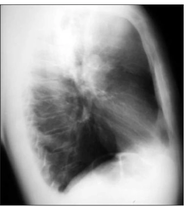 Skiagram hrudníku (pravobočná projekce) – tumor pravé plíce způsobující syndrom horní duté žíly.