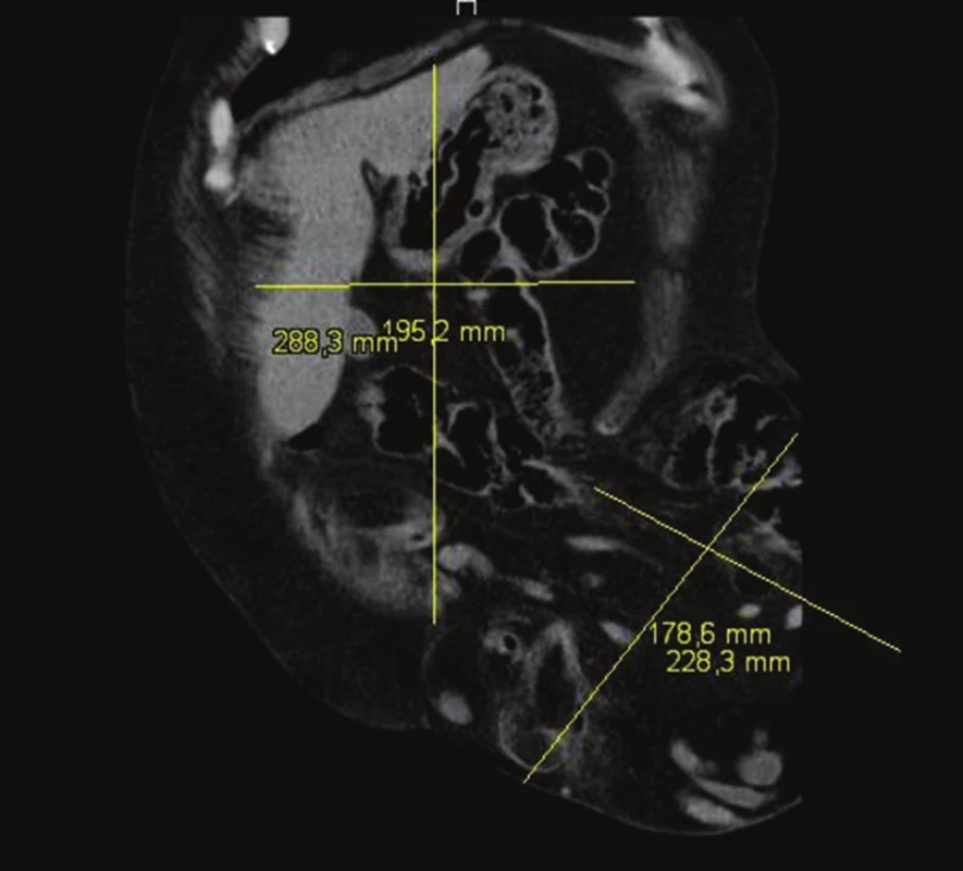 CT volumetrie (frontální část)
Fig. 5: CT volumetry (coronal part)