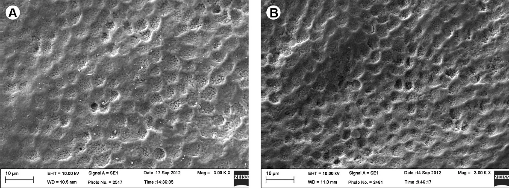 SEM analysis. A: Specimen subjected to cariogenic challenge. The enamel porous surface aspect presents partial dissolution of the aprismatic layer (arrow) (3,000×). B: Specimen subjected to cariogenic challenge and bleaching procedure. The substantial dissolution of the aprismatic layer and increased porosity can be observed, allowing visualization of the enamel prism mouths, forming new channels for dissemination (3,000×).