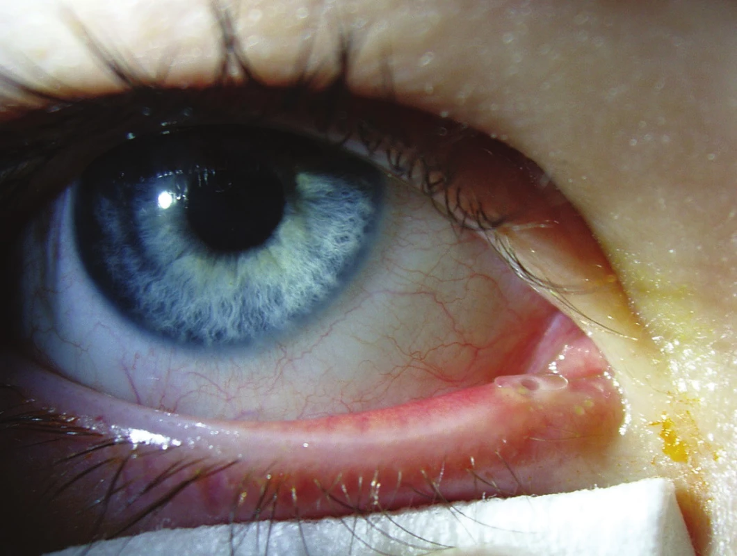 Monokanalikulární intubace pravého oka, silikonová kanyla v dolním slzném bodu