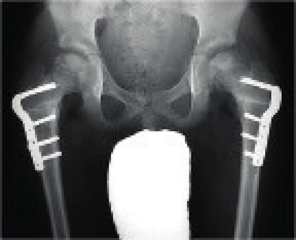 RTG pánve pacienta po oboustranné varizační osteotomii.
Fig. 6. Pelvis X-ray of a patient after a bilateral varus osteotomy.
