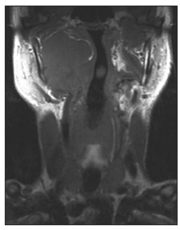 MRI recidivujícího maligního SFT. Parafaryngeální prostor je vyplněn měkkotkáňovou, poskontrastně se sytící izosignální expanzí, jež mediálně vyklenuje laterální stěnu faryngu (T1W obraz, koronální projekce).