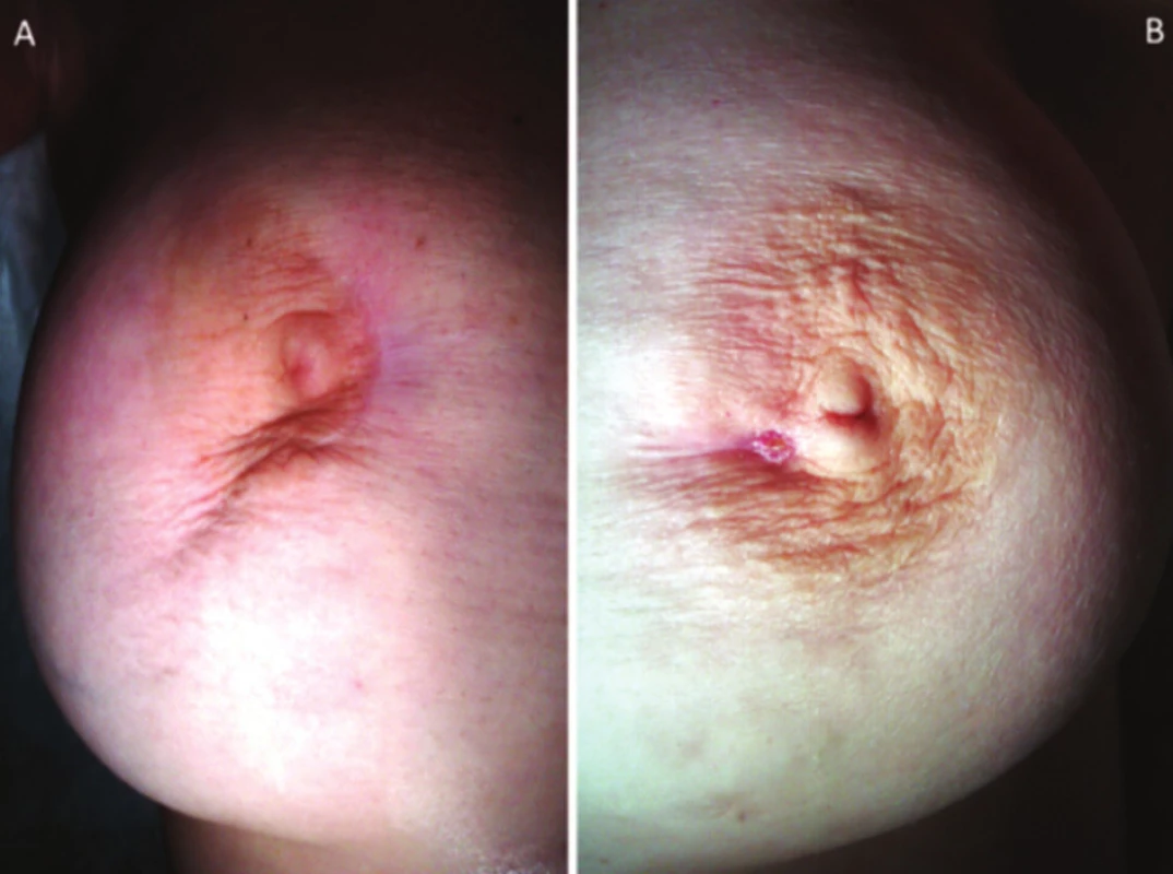 a) pravý prsník – prítomná retrakcia bradavky, periareolárne prítomná jazva po predchádzajúcich incíziách abscesu, b) ľavý prsník – prítomná periareolárna fistula ductus lactiferi a jazva po predchádzajúcich incíziách abscesu
Fig. 1: a) right breast – presentation of the nipple retraction, a periareolar scar after previous incisions of abscess; b) left breast – presentation of the periareolar fistula of lactiferous duct and a scar after previous incisions of abscess