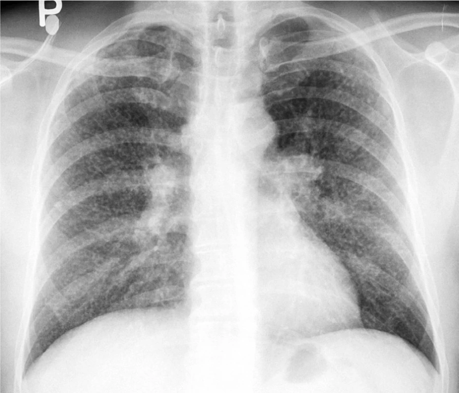 Disperzní mikronodulace v obou plicních křídlech na RTG hrudníku pacienta