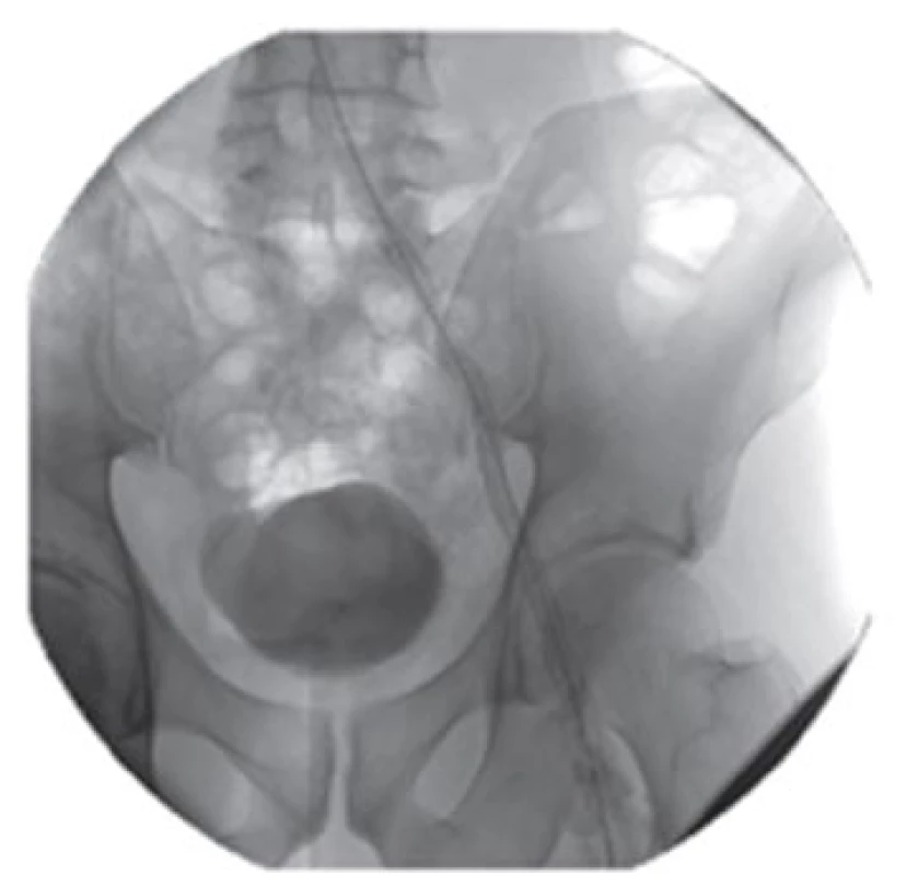 Stenting pánevního řečiště
Fig. 4: Stenting of pelvic vasculature