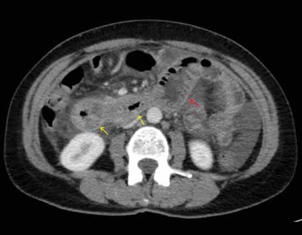CT břicha – zesílená stěna zachycených kliček jejuna s edémem řas (žluté šipky), dilatace kličky orálního jejuna (červená šipka), zachycena volná tekutina především vlevo.